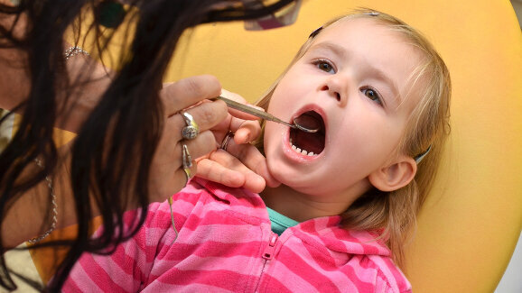 Les consultations précoces chez le dentiste sont essentielles pour prévenir la carie de la petite enfance