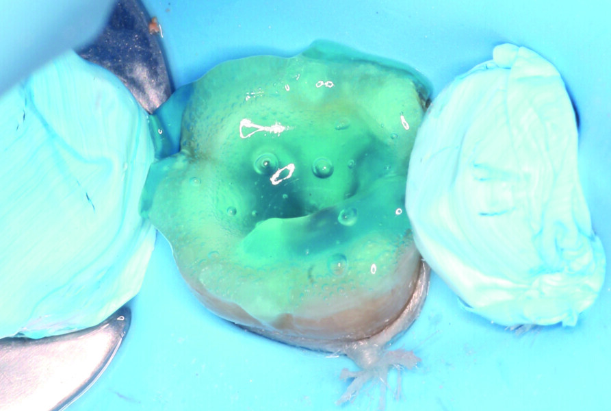 Fig. 12: Total etching of both enamel and dentine with a 37% phosphoric acid gel.