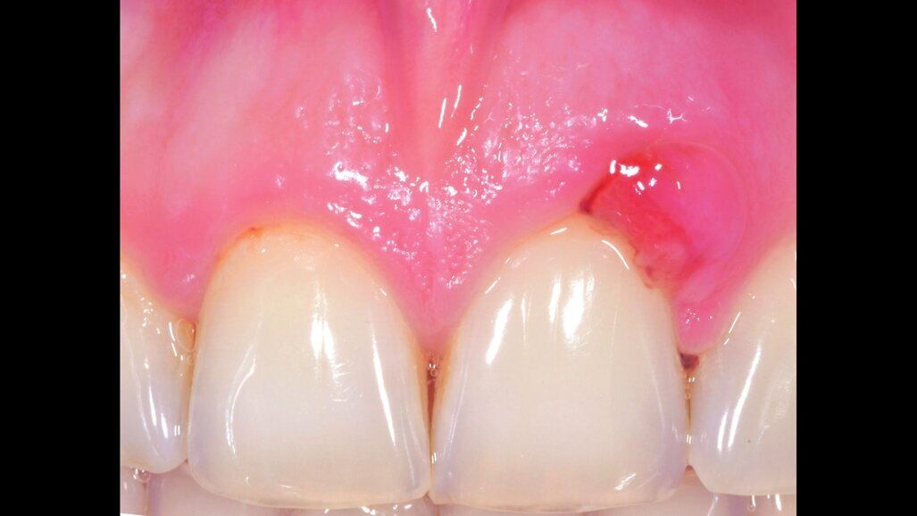 L’uso di ozono stabilizzato  in gel nella terapia parodontale  non chirurgica: case reports