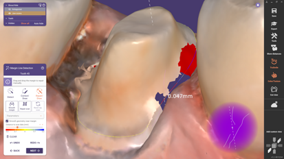 DentalCAD 3.2 enhances precision with new tool for repairing preparation margins