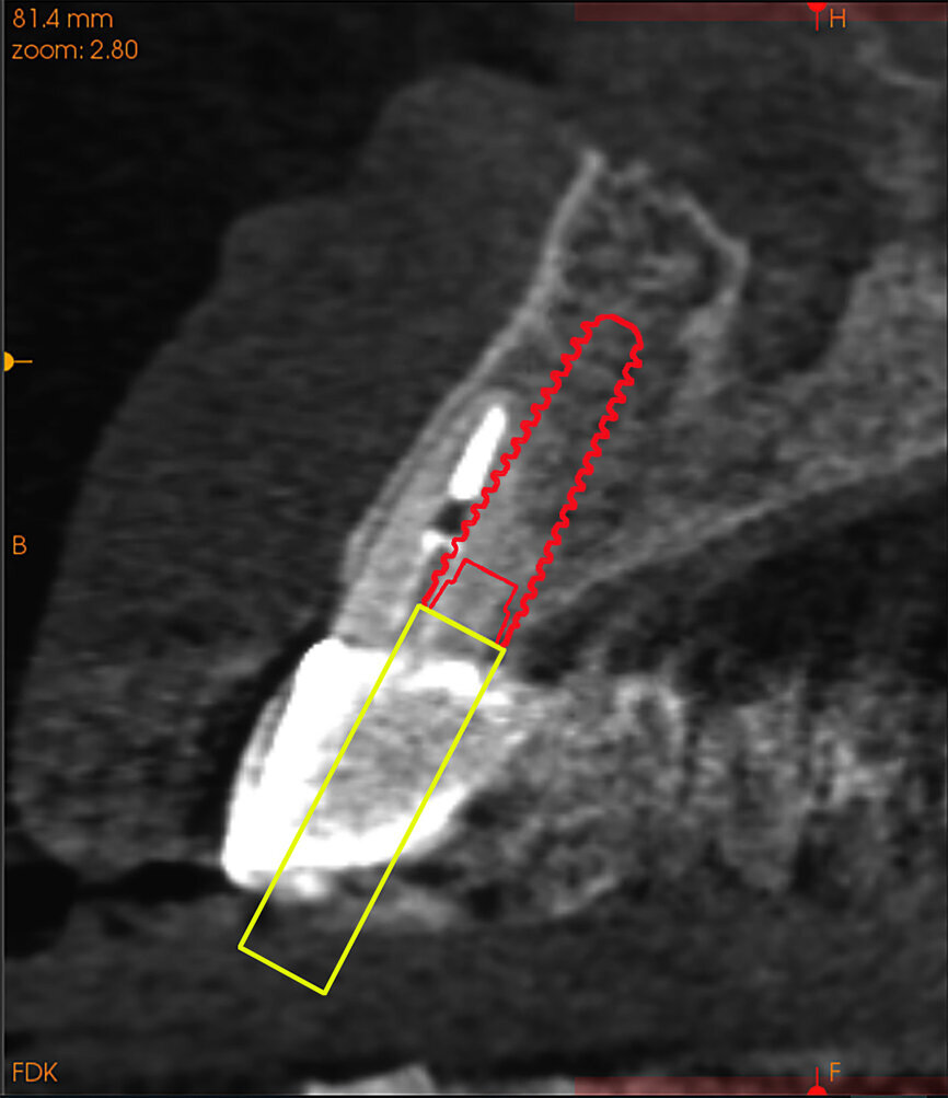 Fig. 14b: Using the native Carestream 3D Imaging Software,
a simulated implant (red outline) and abutment projection (yellow outline) was positioned within the available bone to avoid the root fragment.