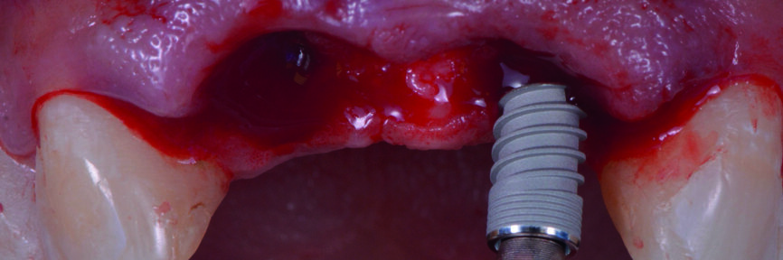 Fig. 15 : Pose de l’implant. 