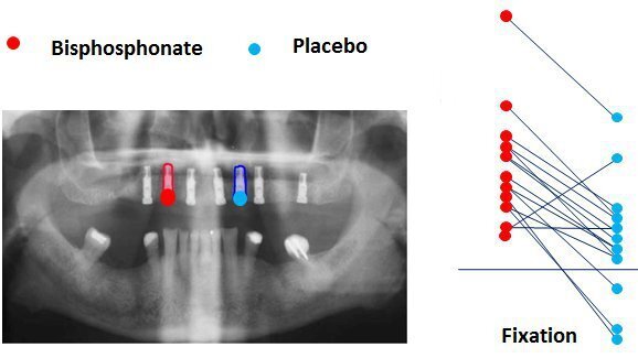 Un nouveau revêtement accélère la fixation des implants dentaires