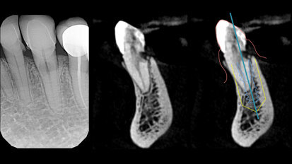 Riassorbimento radicolare esterno trattato con Socket-Shield Technique. Studio del matching degli STL e conferme volumetriche sui pattern di guarigione