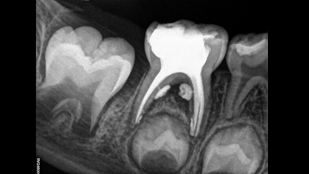 Fig. 3: Three canals, lateral canal filling.