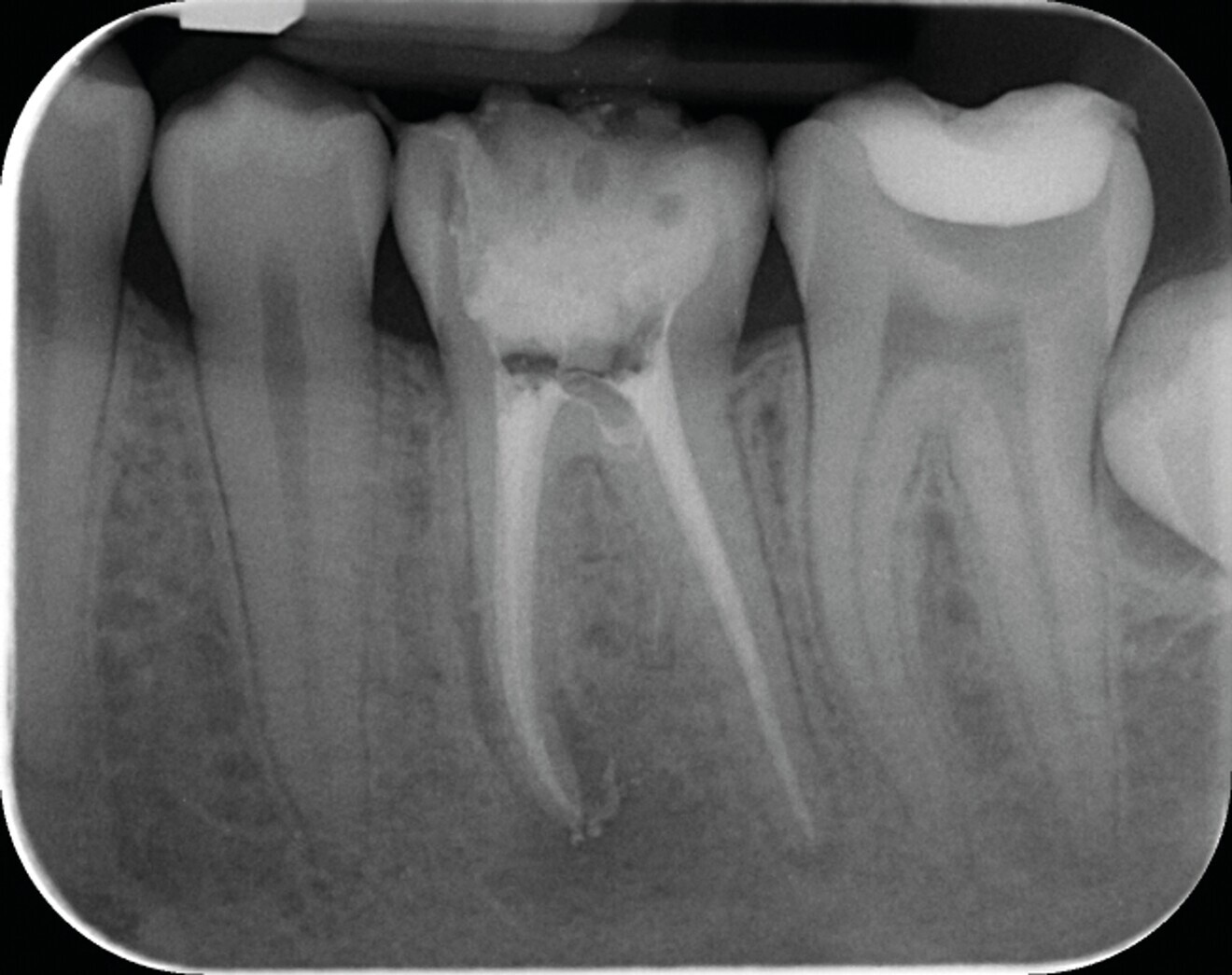 Fig. 7b : Radiographie postopératoire mettant en évidence la préservation maximale de tissu dentaire dans la partie cervicale de la dent, grâce au système SlimShaper. Cette mise en forme préservatrice n’a pas interféré sur le reste de la procédure, elle permet surtout d’éviter d’affaiblir la dent dans la zone cervicale.