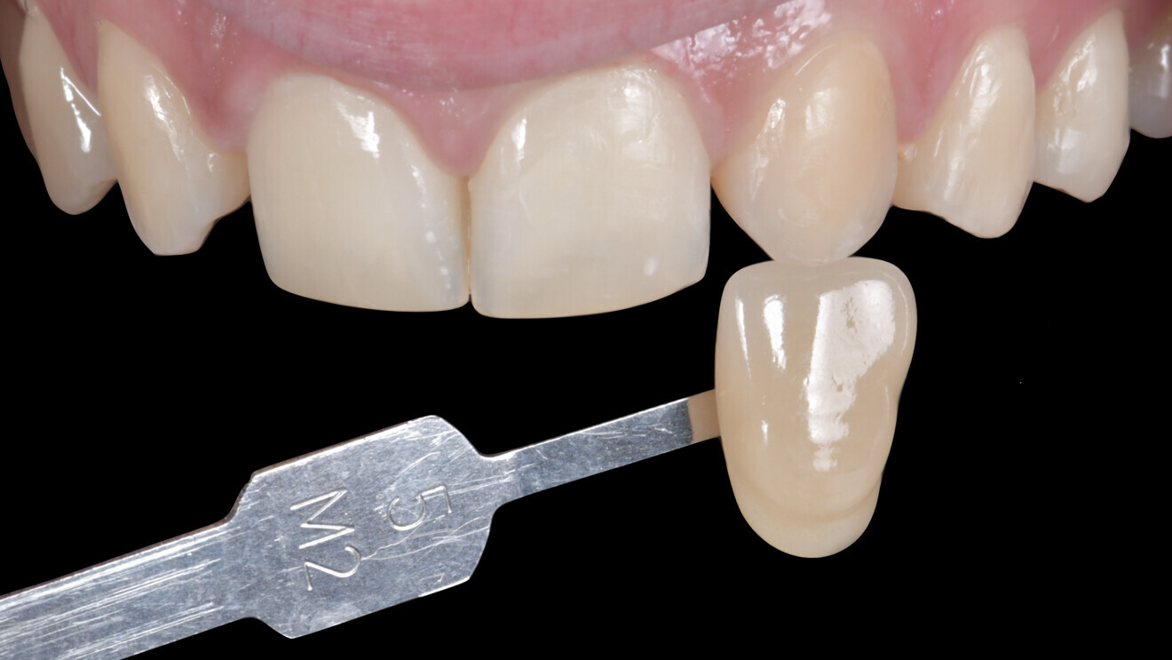 Fig.  4 : Relevé de couleur initial au niveau des dents 13, 23 (5M2).