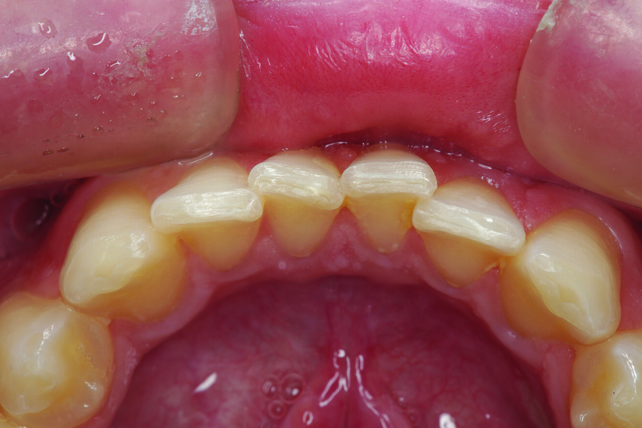 Fig. 3: Incisal view showing that tooth #41 was the arch form’s most facially positioned mandibular incisor.