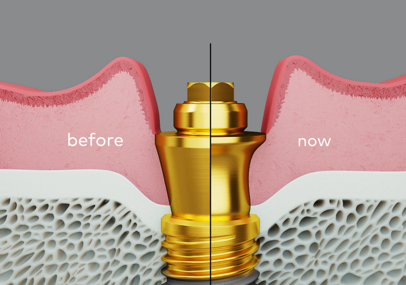 Nobel Biocare – multi-unit abutments