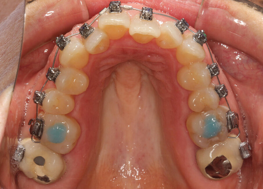 Initial treatment