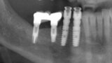 Figs. 10. Colocación de 2 implantes post-extracción en posiciones del 43 y 44 y control radiográfico post-extracción.