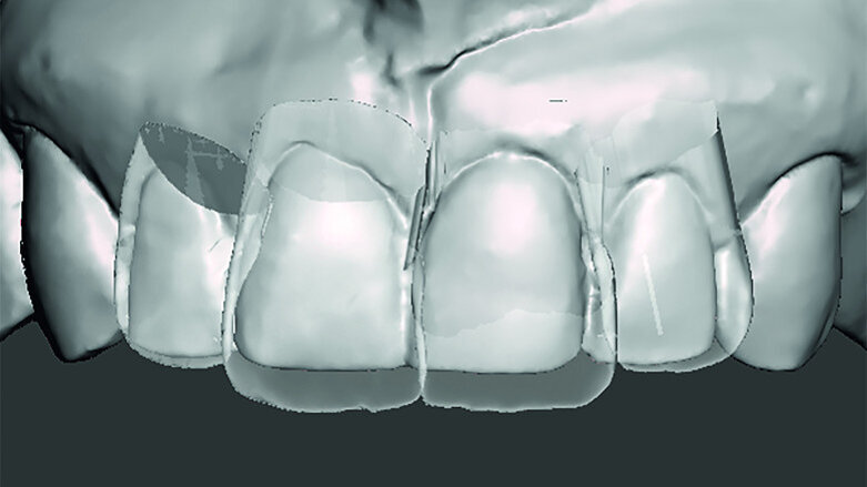 Aesthetic Digital Smile Design: 2-D-/3-D-assisted communication and software design