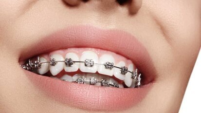 Un adhesivo que evita las caries en los brackets