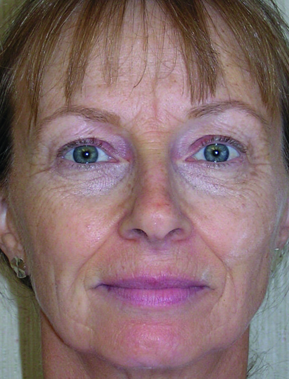 Fig.3 : Prétraitement facial, post-traitement facial six mois et neuf mois après, et enfin, évaluation morphométrique du changement.
