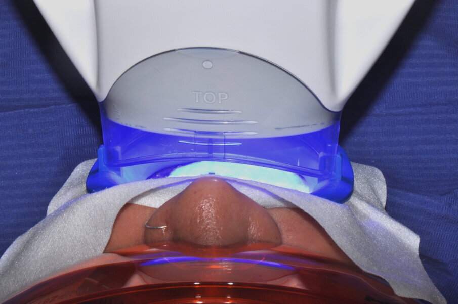 Fig. 3 - Attivazione del gel sbiancante attraverso lampada attivatrice (Phillips®).
