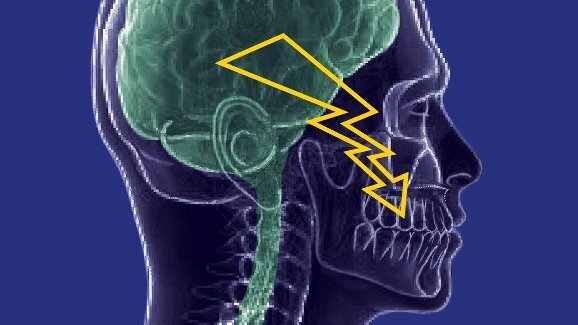 Pesquisadores a desenvolvem tratamento para dor do nervo que afetam os dentes e o rosto