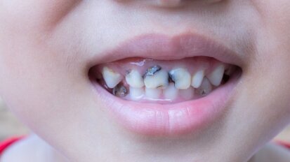 Интервю: В обществата без флуорирана вода има повече случаи на зъбен кариес