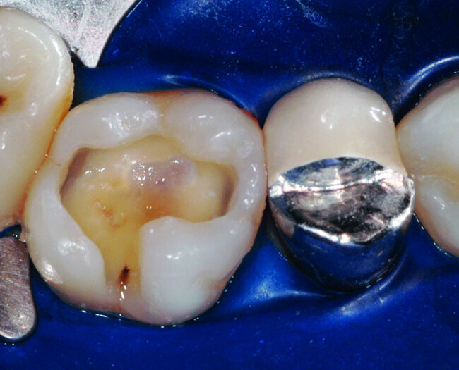 Fig.11 : Vue clinique apres curetage de la lésion carieuse. On note que le plancher dentinaire est de fine épaisseur car nous voyons le parenchyme
pulpaire par transparence. Afin d’éviter toute sensibilité post-opératoire l’utilisation d’un substitut dentinaire est preconisée. 