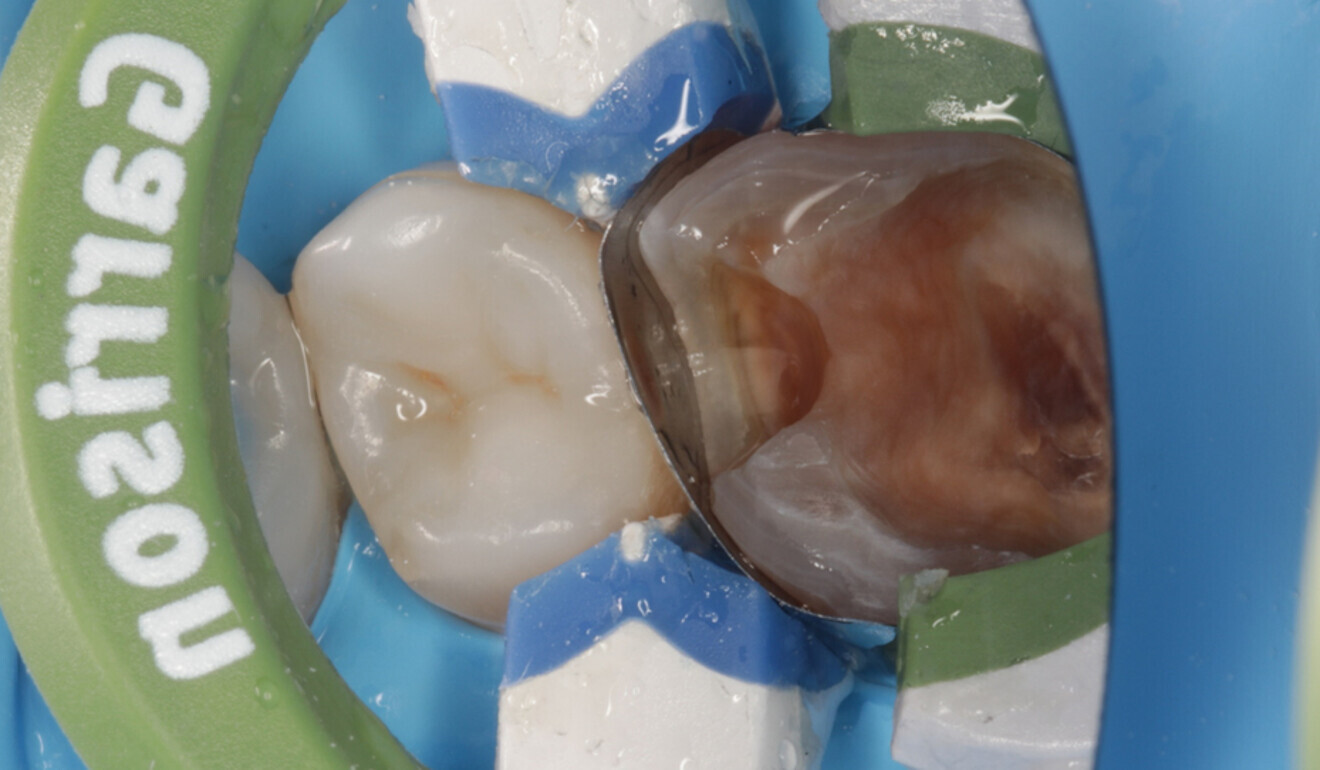 Fig. 8: Mesial matrix fit. (Image: Kuraray Noritake Dental)