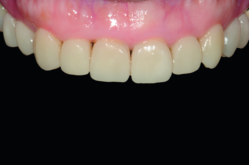 Fig. 21: Try-in: frontal view of upper anterior dentition.