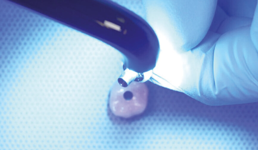 Fig. 2: Light-polymerise the block-out resin. 