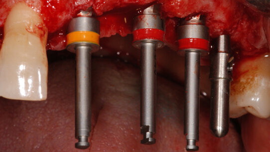 Riabilitazione di un caso complesso con impianti in zirconia