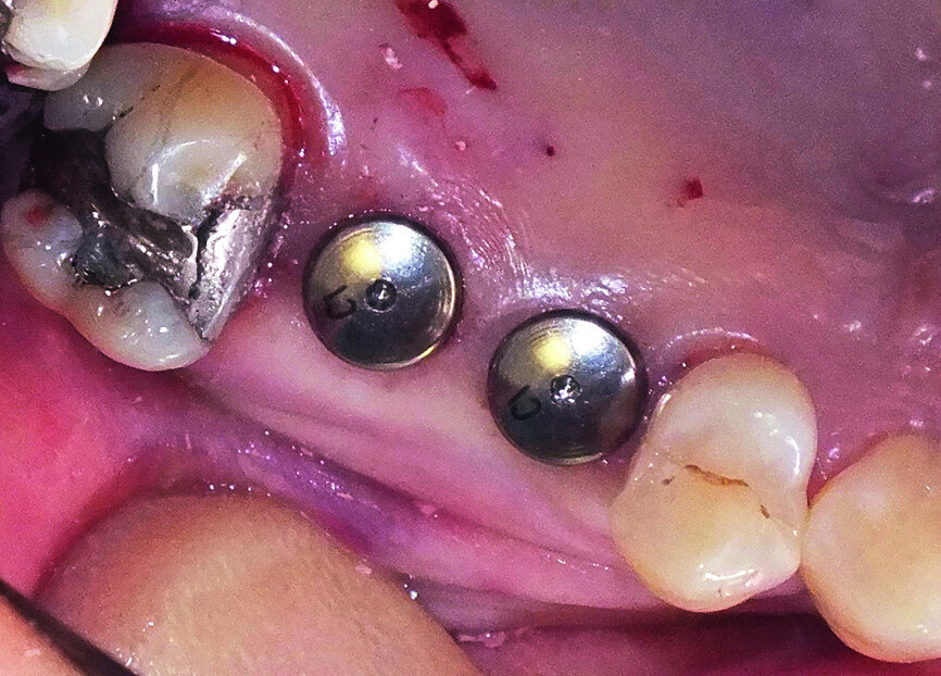 Fig. 18: Ankylos Balance posterior sulcus formers were fitted, without the need for additional closure with sutures.
