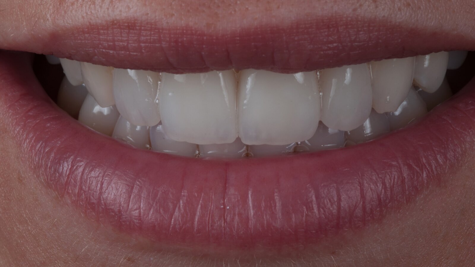 Surface texture: Using horizontal and vertical lines to simulate natural tooth appearance—Theory and technical procedure of lines