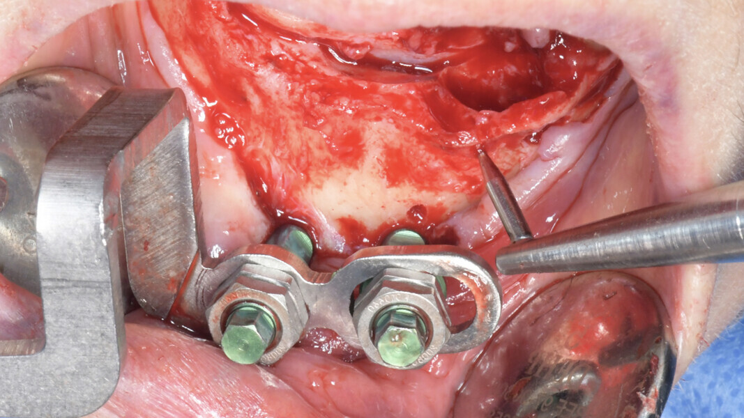 Fig. 9: Navigated implant surgery (EDX patient tracker arm attached).