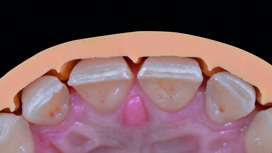 Fig. 9b : Vérification de la profondeur de la préparation au moyen de la clé en silicone, face palatine. 