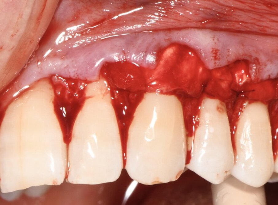 Fig. 5 - Apposizione della matrice collagenica tridimensionale di origine equina, fissata con punti staccati alla base delle papille anatomiche, imbibita di sangue per ottenere la copertura radicolare degli elementi 23-25.