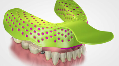 Study compares accuracy of open and closed implant impression techniques
