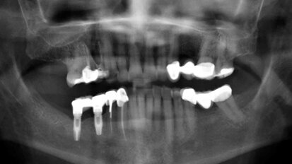 Fig. 2. Radiografía panorámica previa a la intervención quirúrgica.