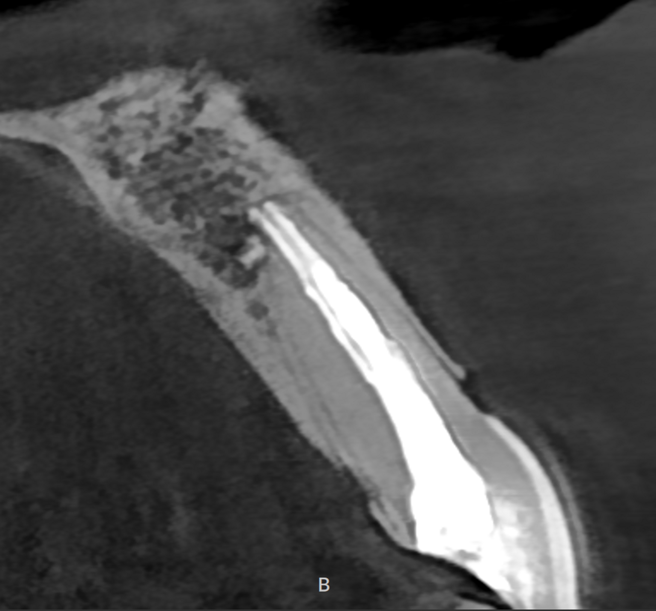 Fig. 3: Retreatment of the central incisor, after the shaping and obturation of both canals.