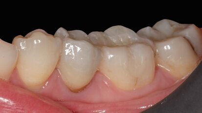 Daily aesthetic dentistry: The contribution of the spectrophotometer