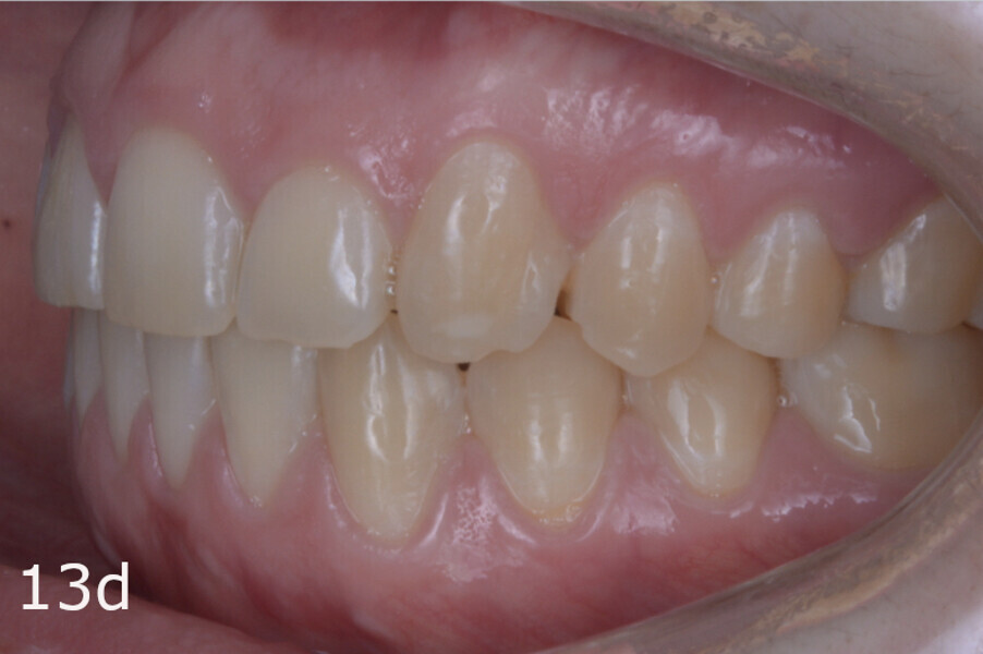 Figs. 13a–f: Final situation. The lack of overjet and overbite and the midlines had been improved and anterior and canine guidance achieved.