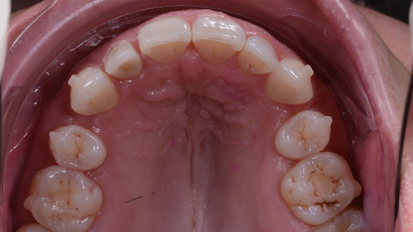 Fig. 4: Before beginning the 18-month retreatment.