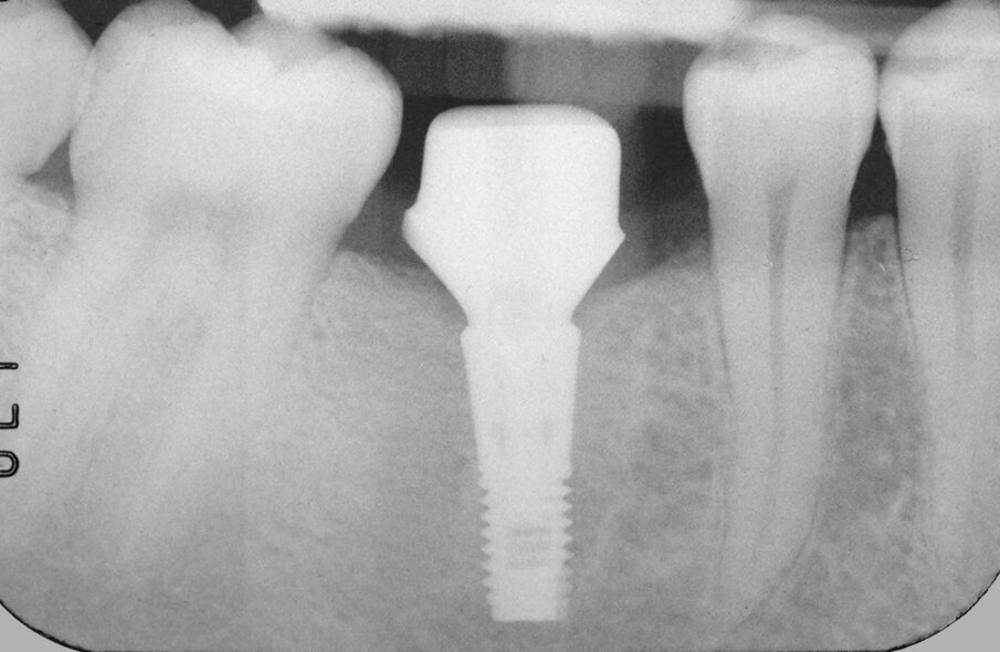 Fig. 15: Verification of correct seating of the abutment using a radiographic image. Note that the transitional portion of the abutment followed the contour of the bone.