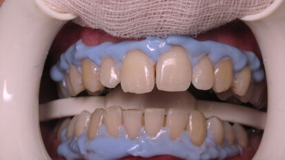Figura 2. Protección de tejidos blandos durante un procedimiento de blanqueamiento dental en consultorio.