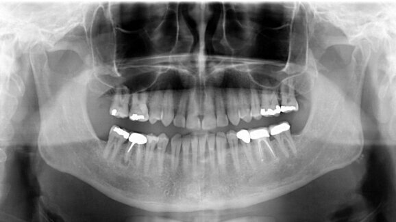 Kiedy leczyć, a kiedy podjąć decyzję o ekstrakcji – rola diagnostyki 3D w zwiększaniu skuteczności leczenia