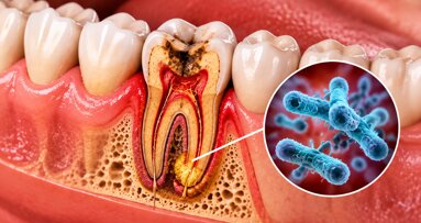 Las infecciones dentales no tratadas pueden causar complicaciones cardiacas