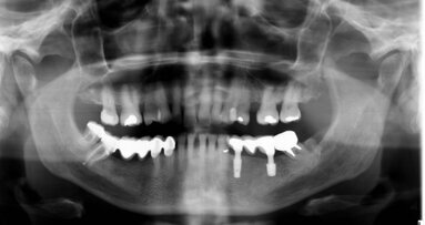 Prosthetic rehabilitation with short GTB implants: A case report with nine-year follow-up