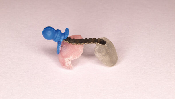 Biomecánica en la técnica CLO3 (Custom-made Lingual Orthodontics in 3 steps – Ortodoncia Lingual Personalizada en 3 pasos)