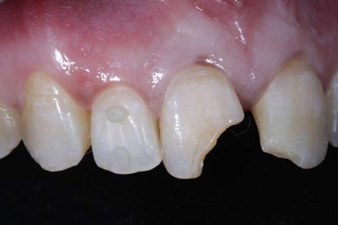 Fig 3 Shade