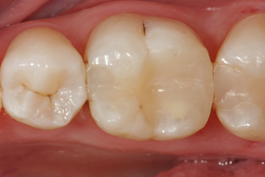Fig. 1d: (a) Deep carious lesion. (b) Partial pulpotomy. (c) MTA application with the MAP System and PD MTA White. (d) Filling. (e) Post-op radiograph showing the pulp capping with MTA.