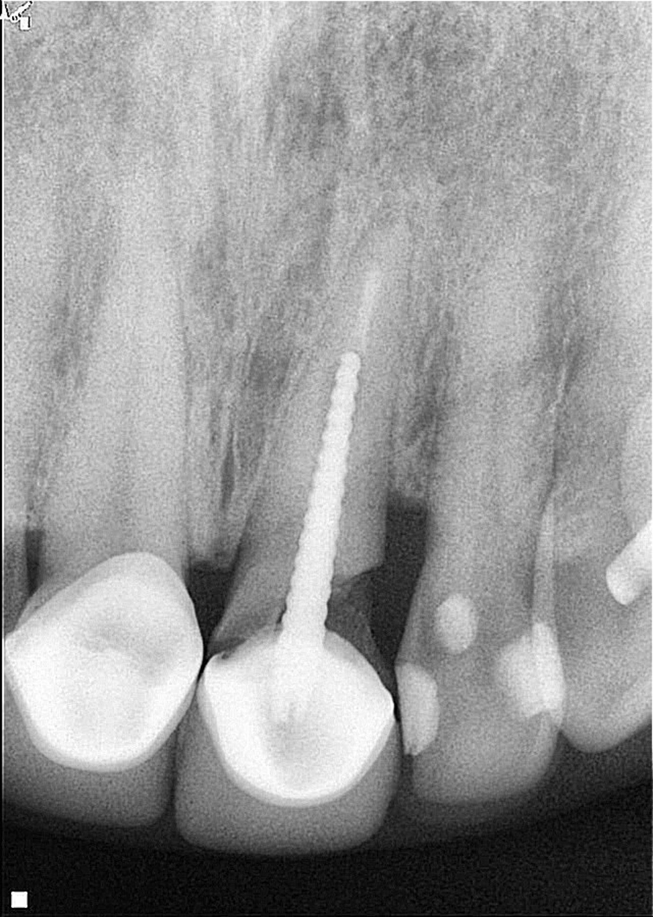 Fig. 1: Initial clinical radiograph showing tooth #21 with a previous root canal treatment, a metal post, a full-coverage coronal restoration and an oblique fracture from the mesial to distal aspect. 