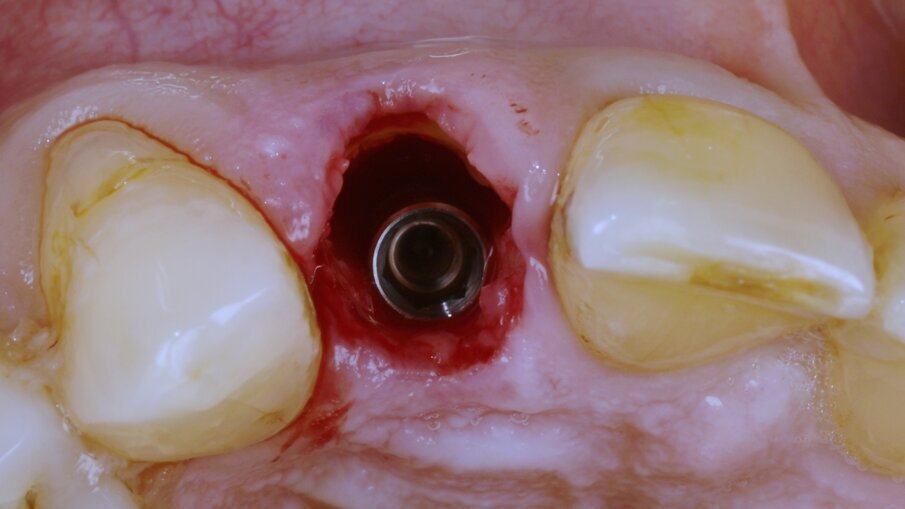 Udatta Kher socket shield 1