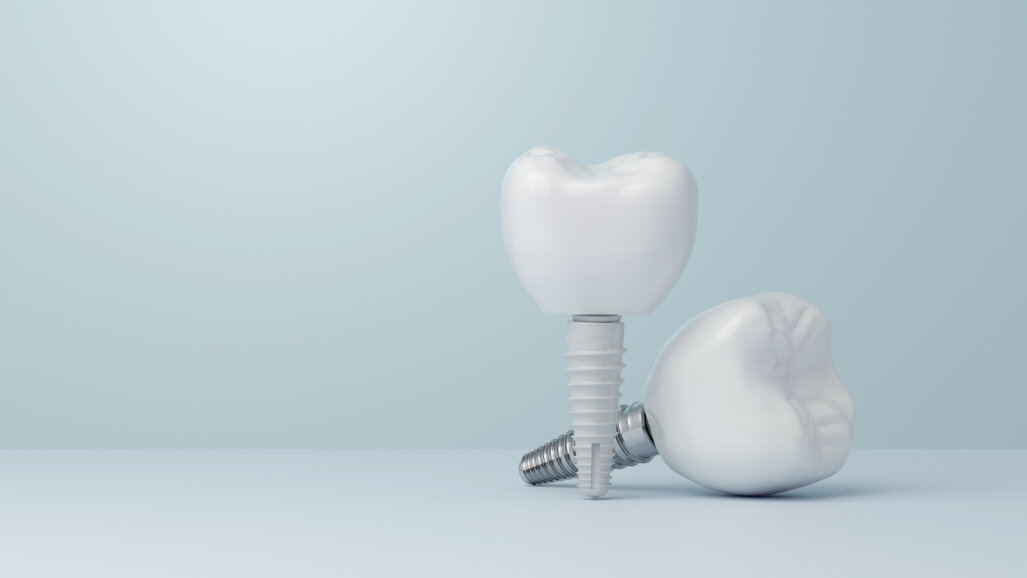 Implants dentaires : une étude suggère que la zircone induit une activation immunitaire plus importante en phase précoce