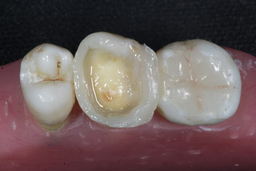 Fig. 37b: Missing walls are restored with a composite enamel layer (Estelite), converting the lesion to a Class I cavity.