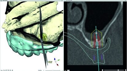 Digital possibilities for making implant prosthetics